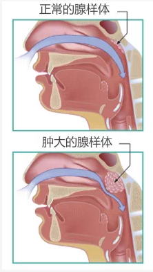 英国IFA芳疗师论文作业荟尚芳疗师学员案例之儿童腺体肿大