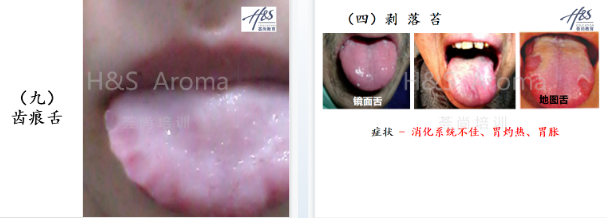 中医芳疗师怎样通过舌头诊断病人情况